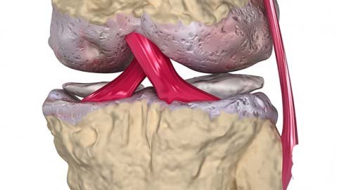  ترميم الرباط الصليبي 