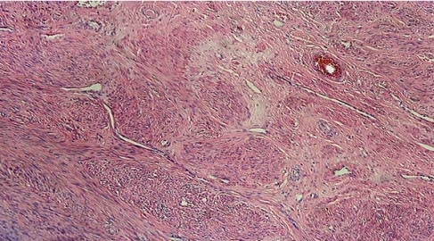  الألياف الرحمية مشكلة تؤرق النساء 