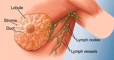 تناول الفتيات للكحوليات فى المراهقة يزيد خطر إصابتهن بسرطان الثدى