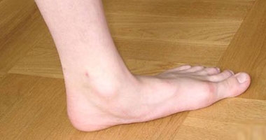 كيف يتم علاج قرحة القدم؟