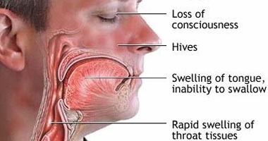 استشارى أنف وأذن: الغرغرة بالماء الدافئ تقى من التهابات الحلق