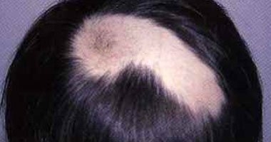 أخصائية جلدية: الكورتيزون والمينوكسيديل أفضل علاج لمرض الثعلبة 