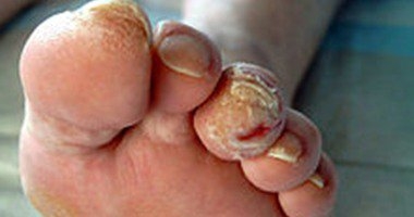 استشارى باطنة يقدم 7 إرشادات ضرورية لمرضى القدم السكرى