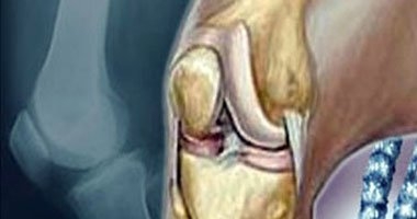 دراسة بريطانية: دعم الأمهات النفسى يخفف آلام مرضى المفاصل 