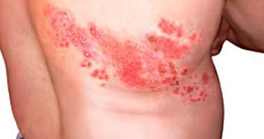 تعرف على أهم علامات الإصابة بالحزام النارى وطرق العلاج